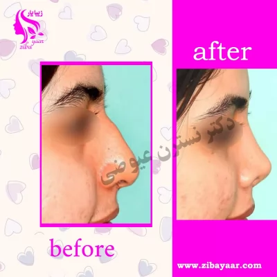 نمونه عمل بینی دکتر نسترن عیوضی
