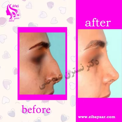 نمونه کار بینی جراحی شده دکتر عیوضی