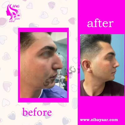 نمونه قبل و بعد عمل بینی دکتر جعفری